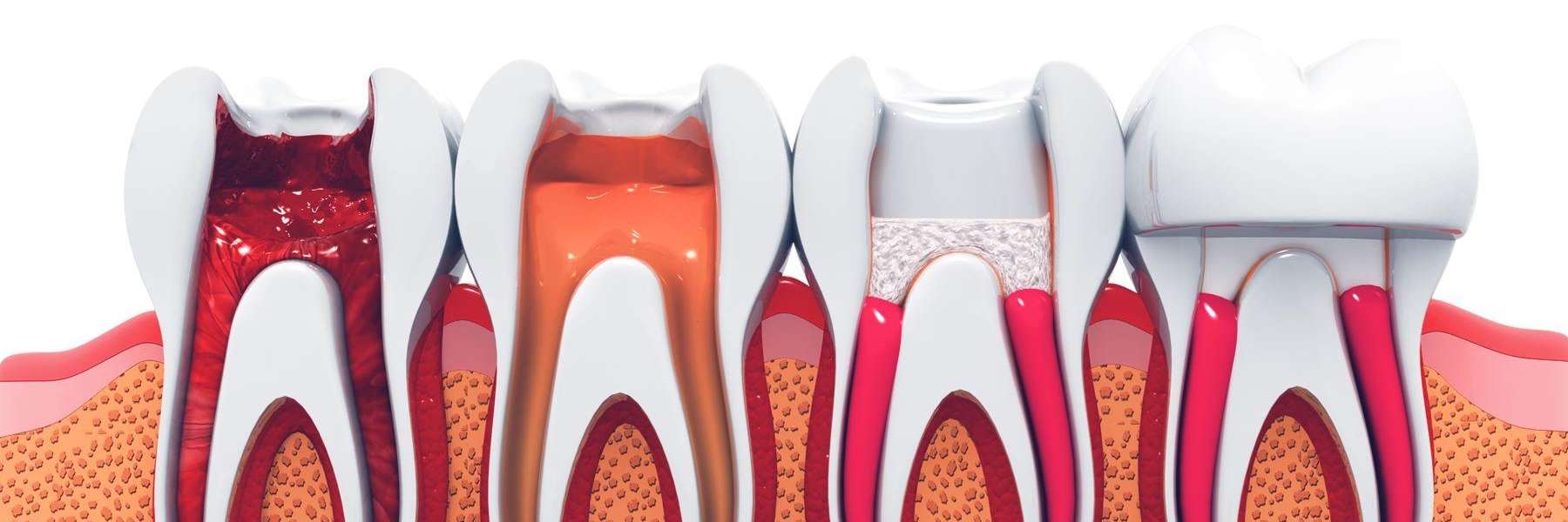 6 Reasons You Might Need a Root Canal Root Canal Treatment Maple Ridge British Columbia 6 Reasons You Might Need a Root Canal Root Canal Treatment Maple Ridge British Columbia