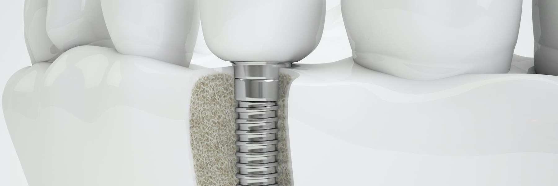 An illustration of a dental implant in Maple Ridge, BC