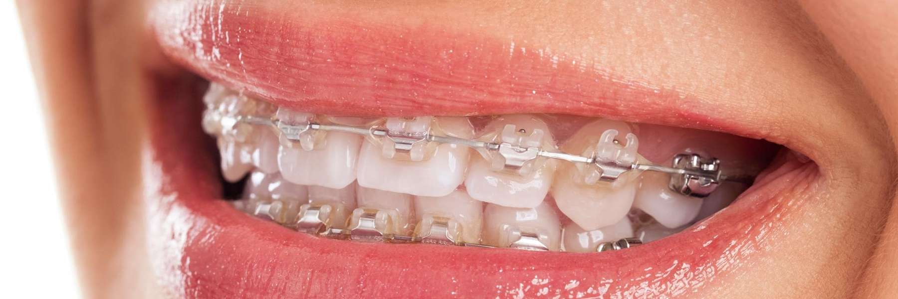 A teen wearing braces
