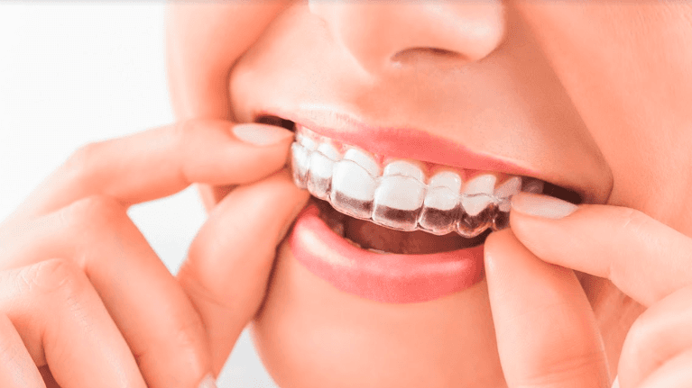 A woman putting in her Invisalign tray | Maple Ridge dentist