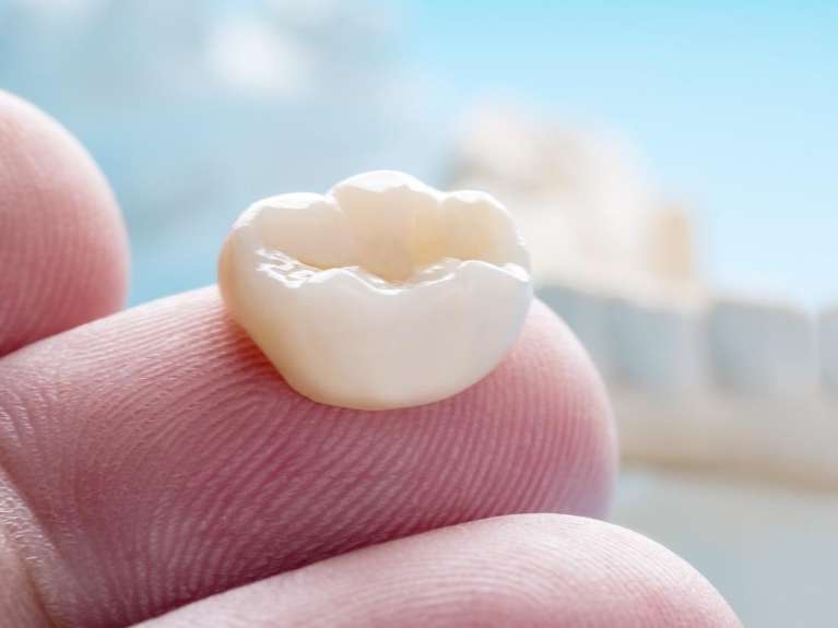 A Dental Crowns in Maple Ridge, BC