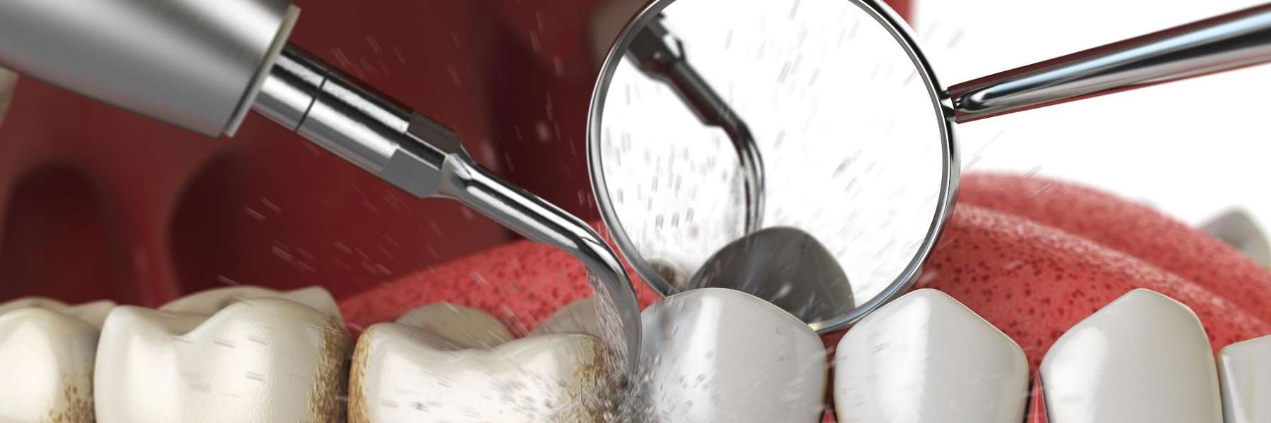 An illustration of a teeth cleaning in Maple Ridge, BC