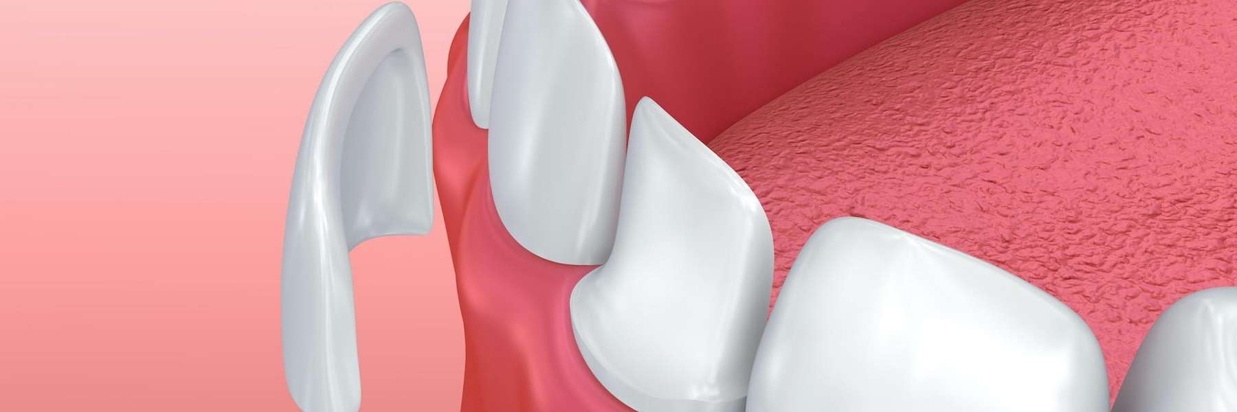 A diagram of dental veneers in Maple Ridge BC