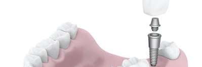 A diagram of a dental implant in maple ridge bc